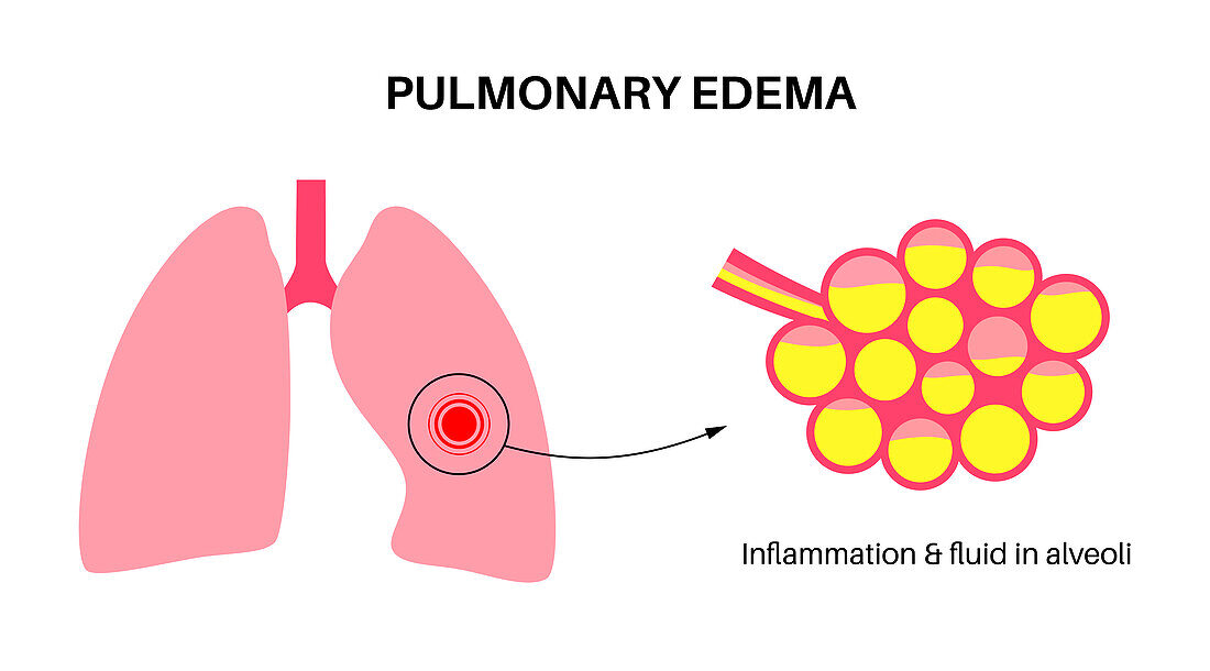 Pulmonary oedema, illustration
