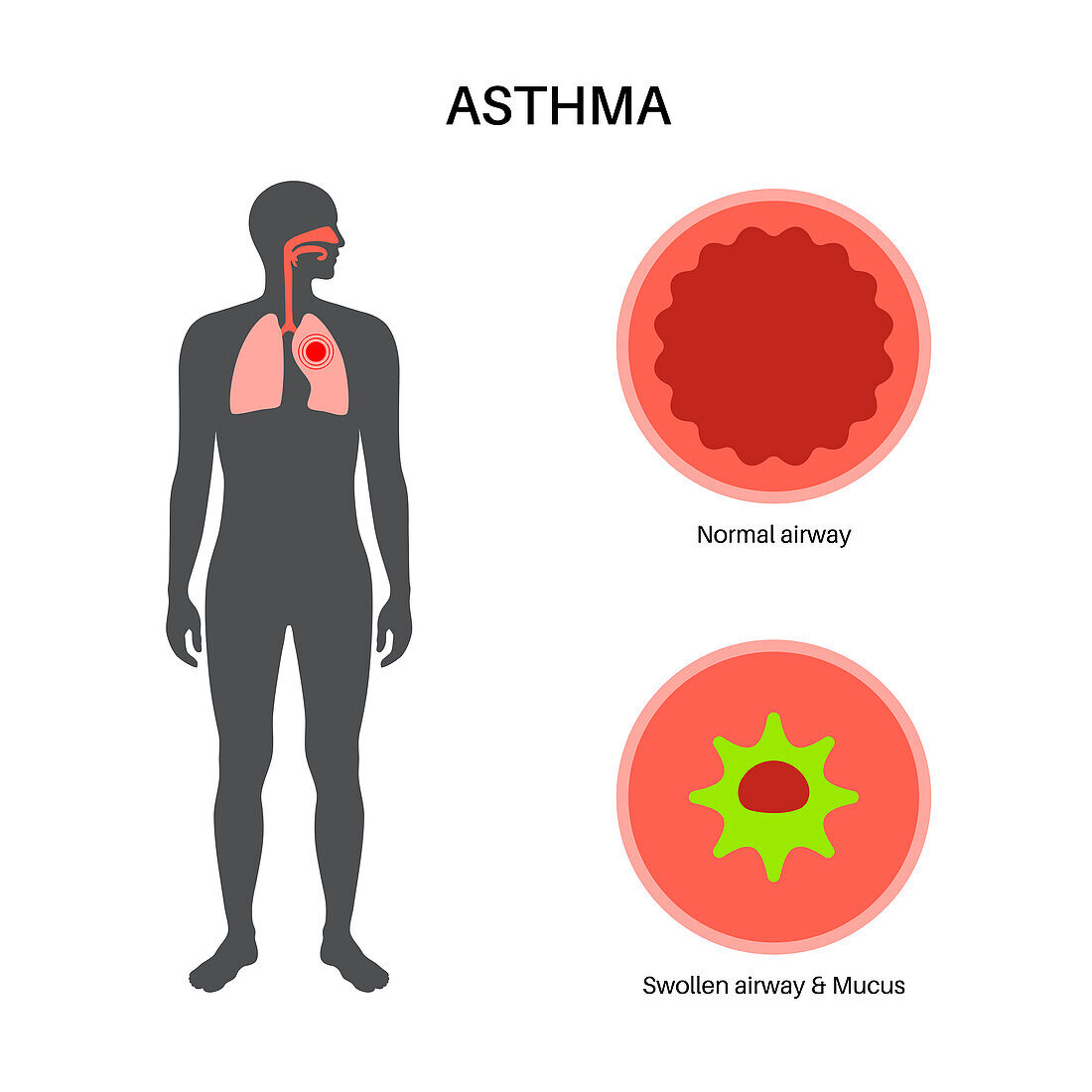Asthma, illustration