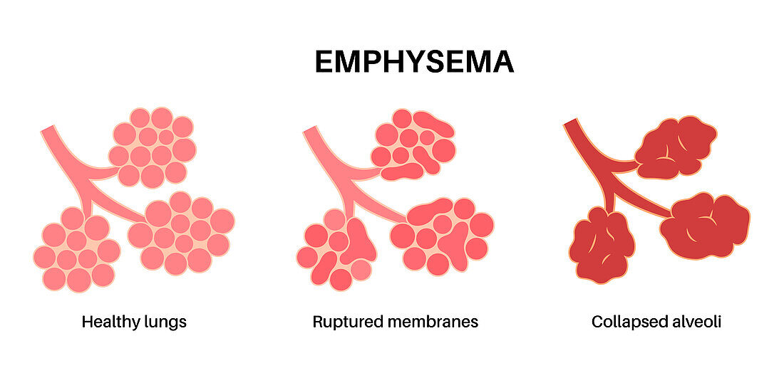 Emphysema, illustration