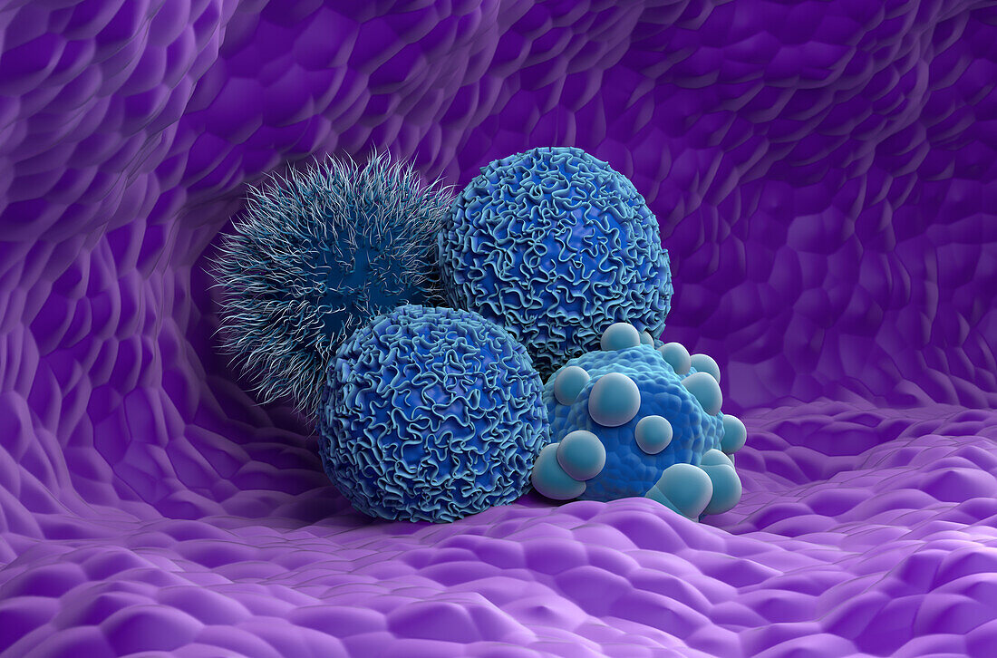 Pancreatic cancer, illustration