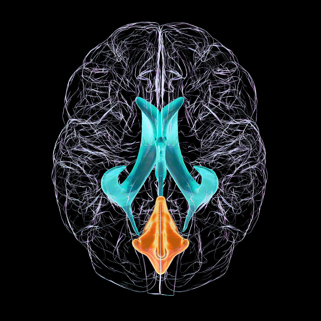 Enlarged fourth ventricle of the brain, illustration