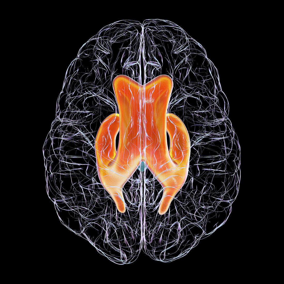 Enlarged lateral ventricles of the brain, illustration