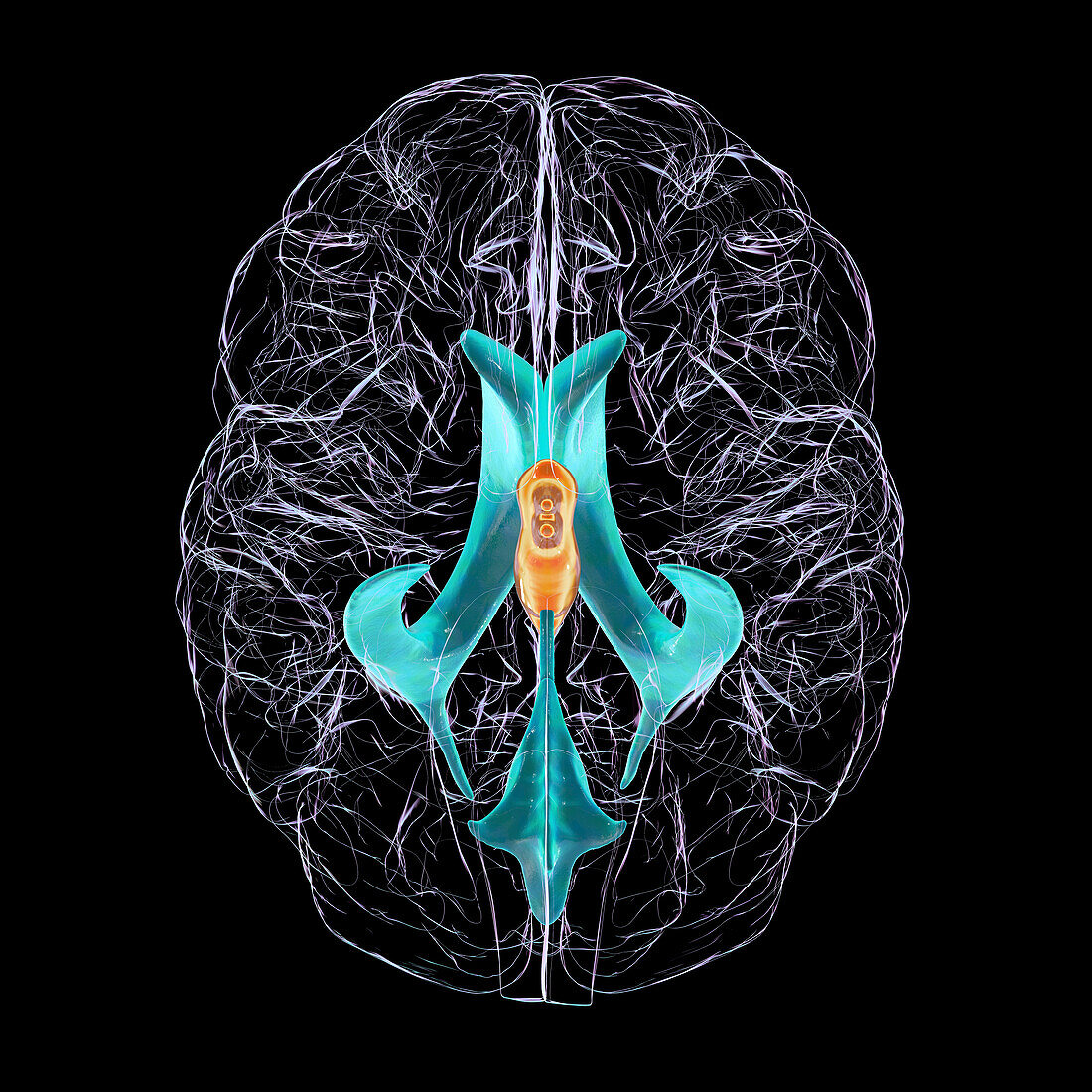 Enlarged third ventricle of the brain, illustration