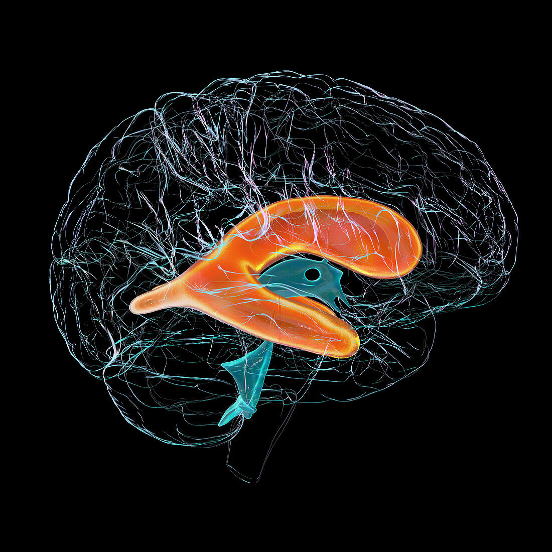 Enlarged lateral ventricles of the brain, illustration