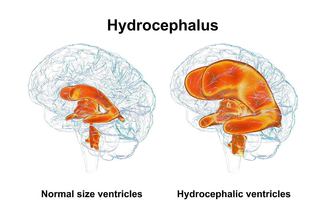 Enlarged and normal brain ventricles, illustration