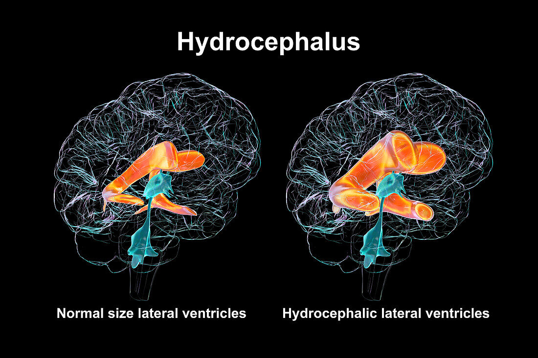 Enlarged and normal brain lateral ventricles, illustration