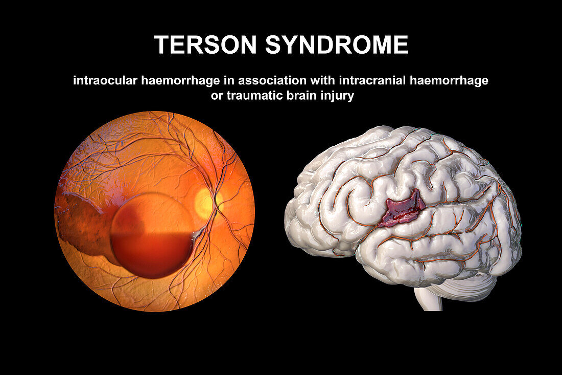 Terson syndrome, illustration