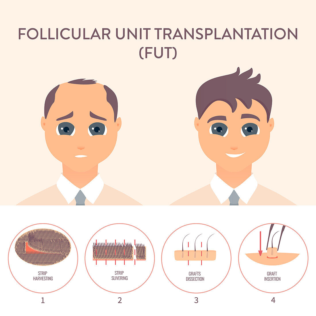 FUT hair transplantation, conceptual illustration