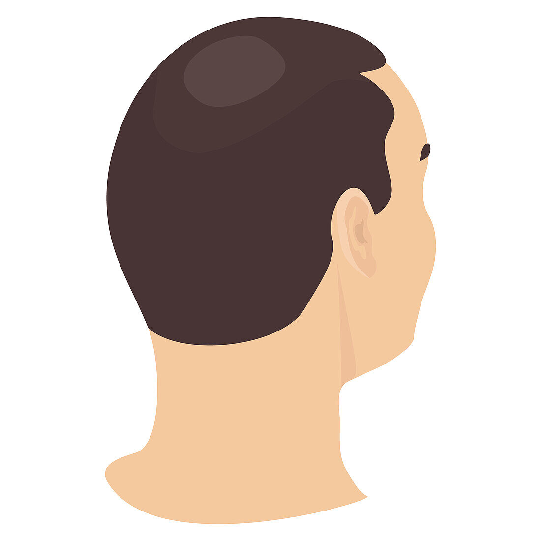 Alopecia in men, conceptual illustration