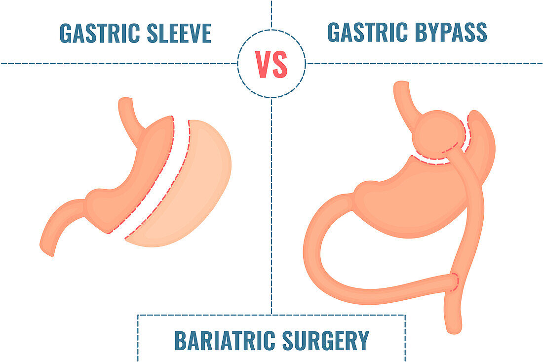 Bariatric surgery, conceptual illustration