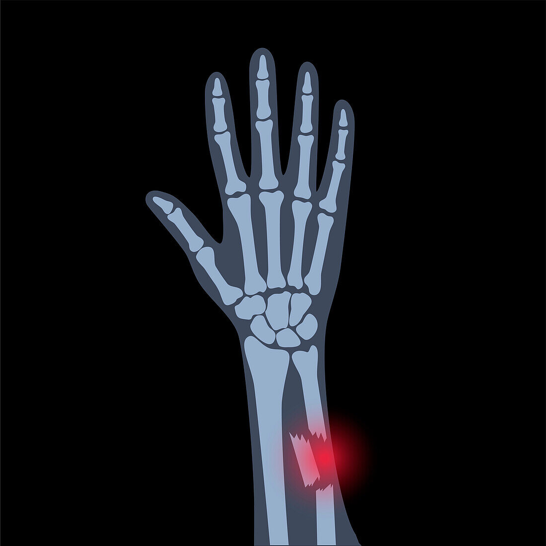 Fractured arm, illustration