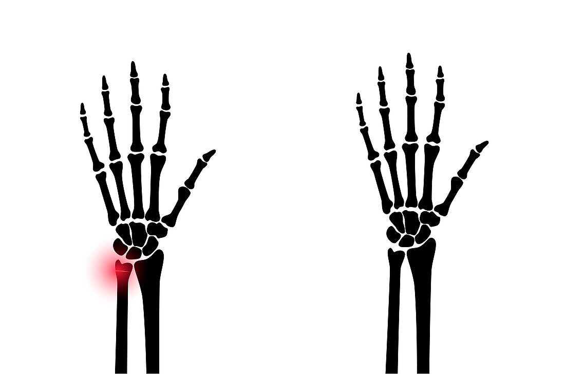 Fractured and healthy wrists, illustration