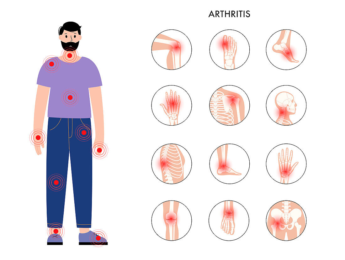 Arthritis, illustration