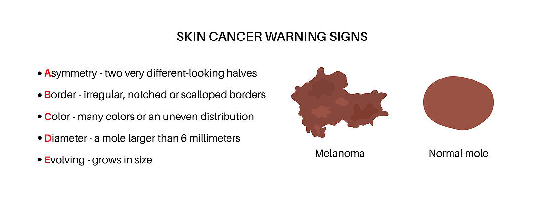 Melanoma warning signs, illustration