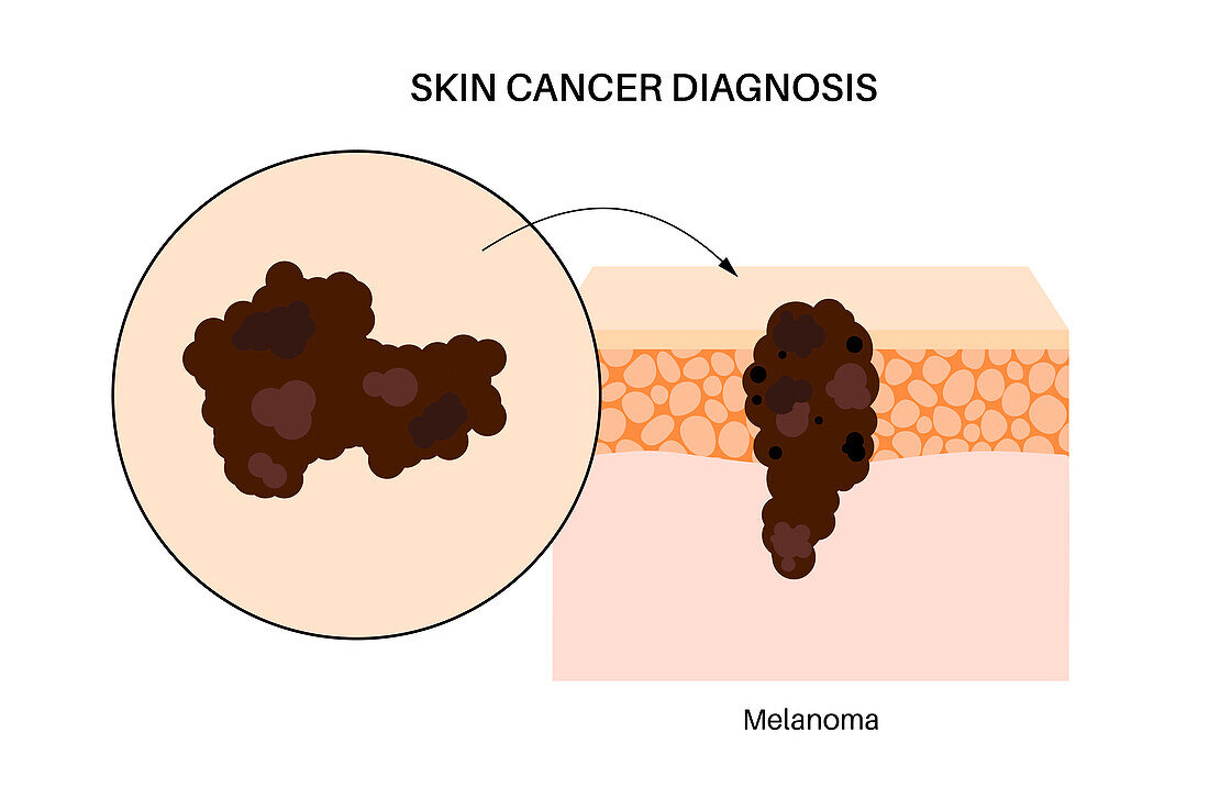 Skin cancer, illustration