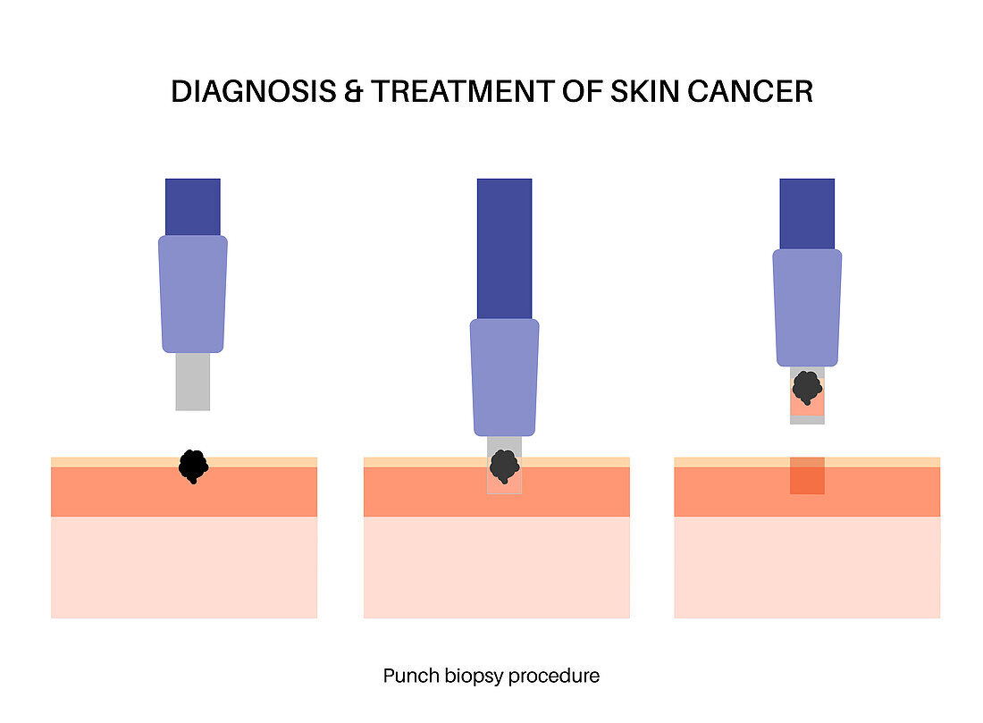 Punch biopsy, illustration