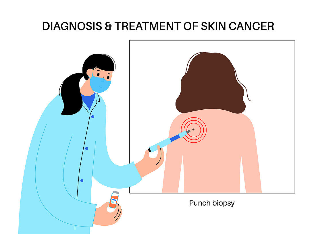 Punch biopsy, illustration