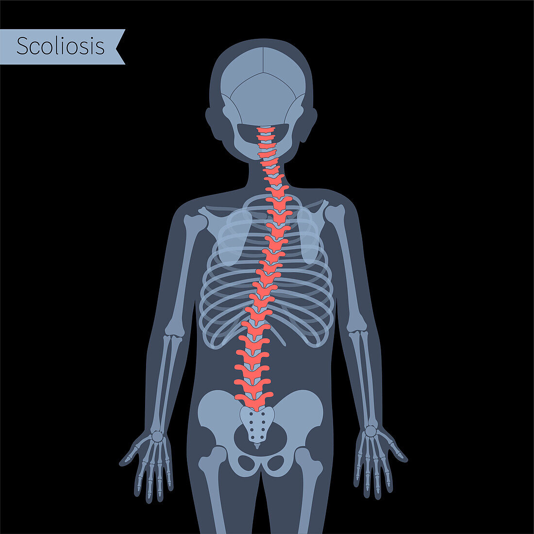 Scoliosis, illustration