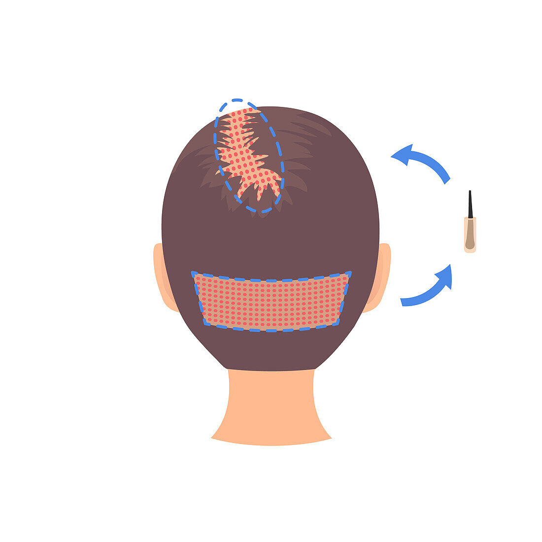 FUE hair transplantation, conceptual illustration