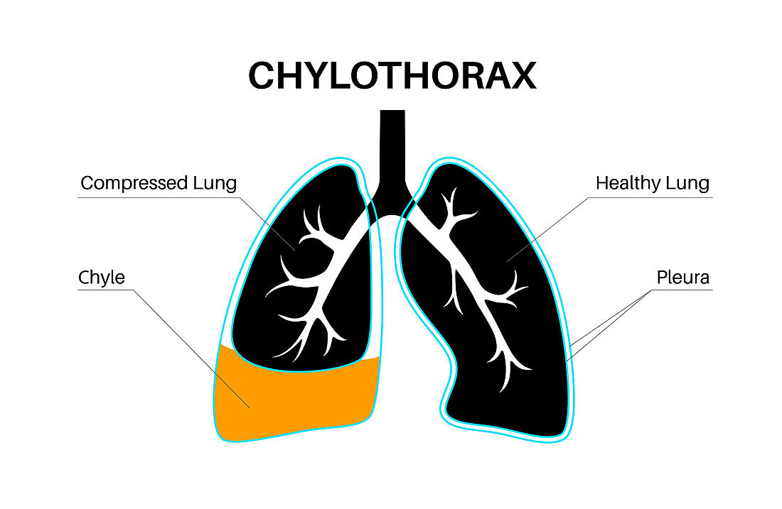 Chylothorax, illustration
