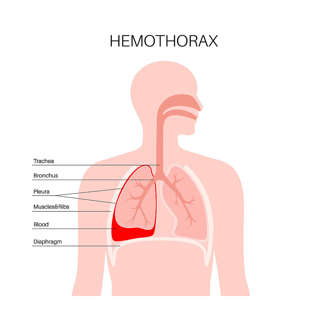 Haemothorax, illustration