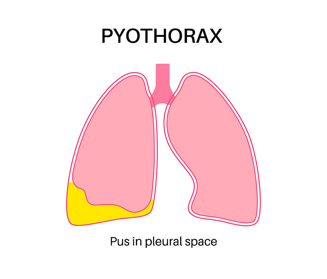 Pyothorax, illustration