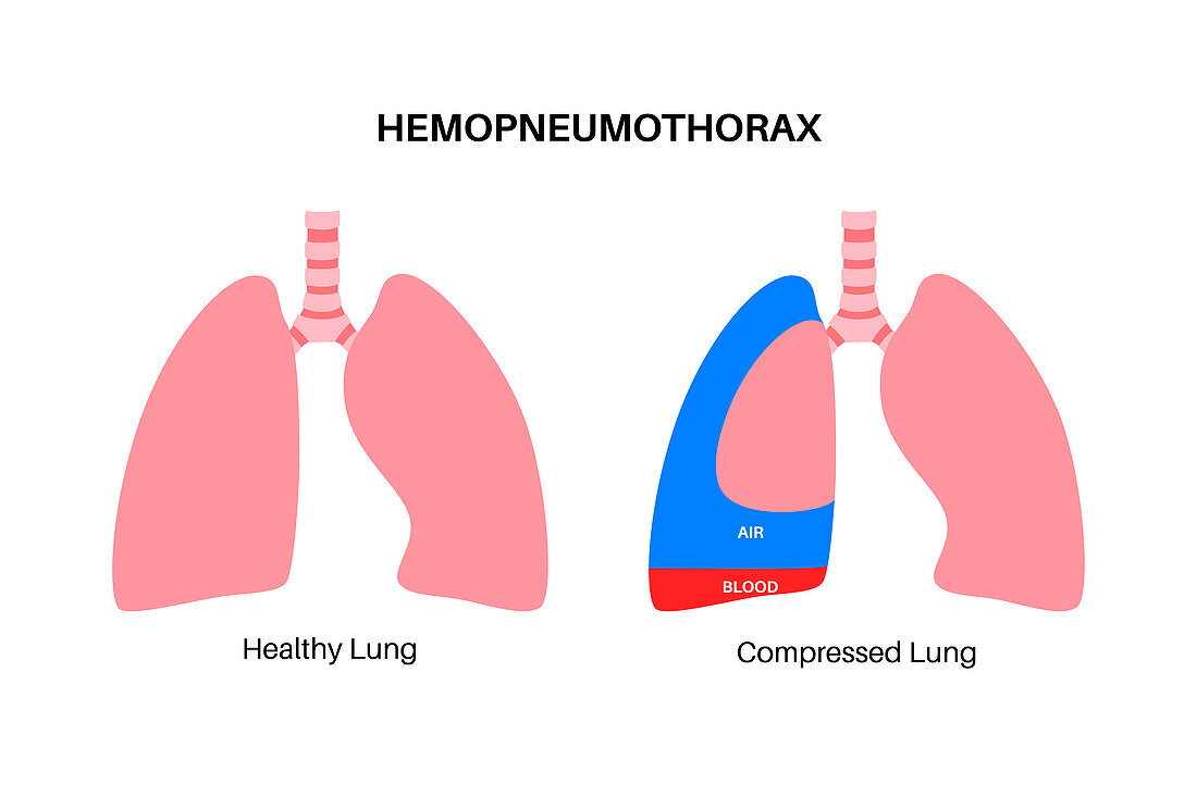 Haemopneumothorax, illustration