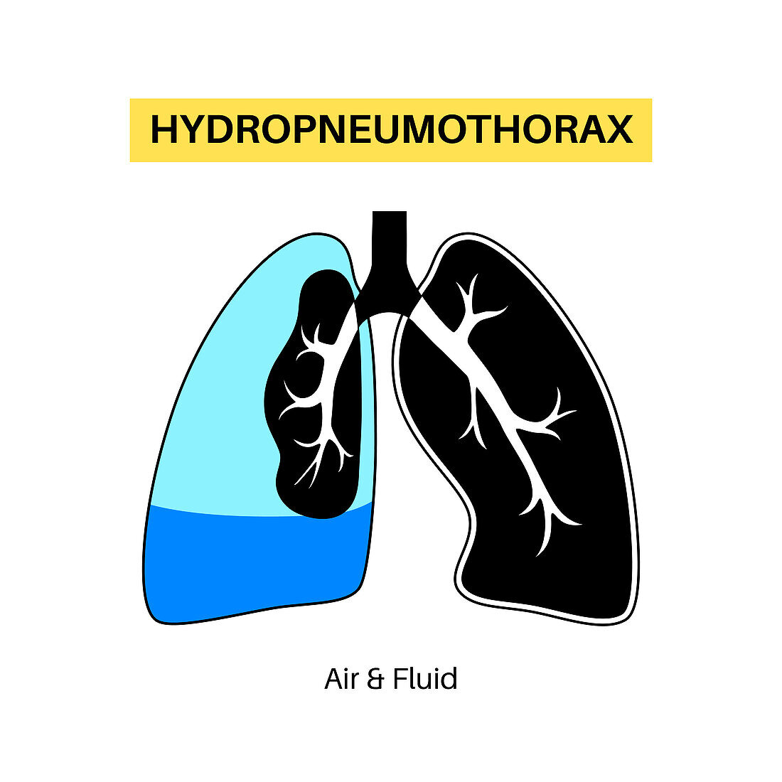 Hydropneumothorax, illustration