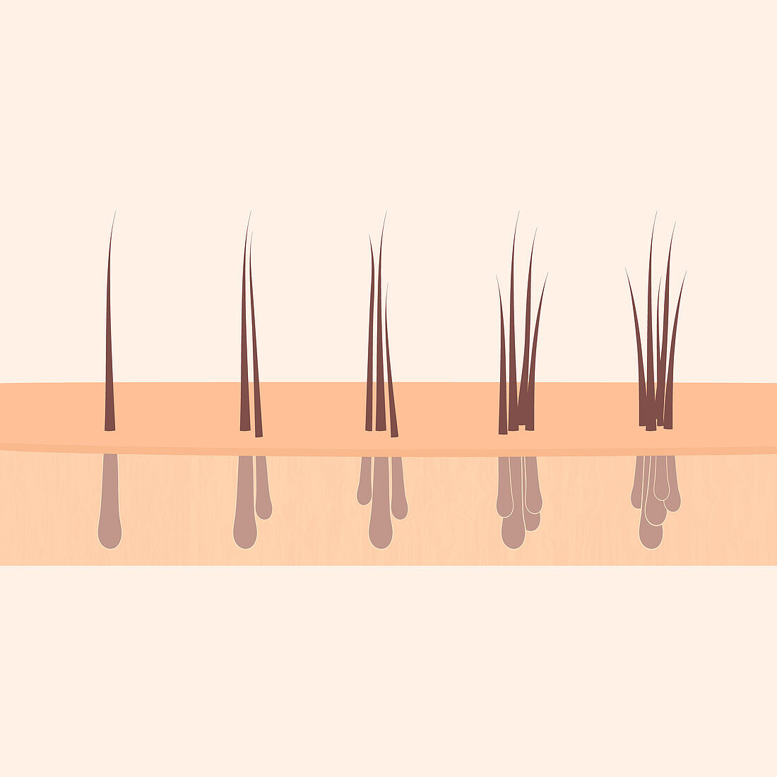 Hair graft types, conceptual illustration