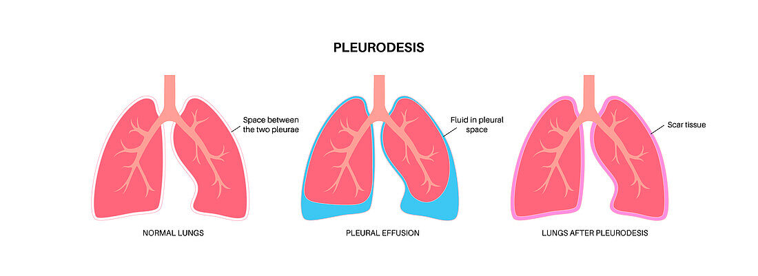 Pleurodesis medical procedure, illustration