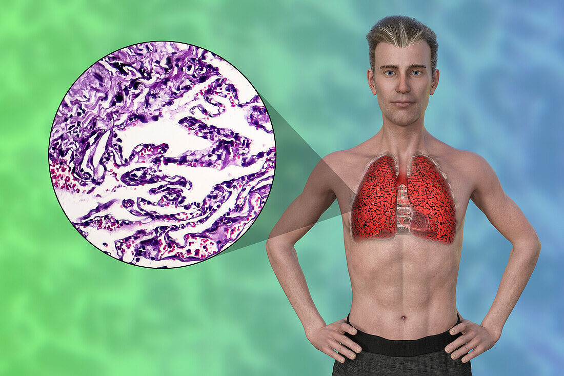 Man with smoker's lungs, illustration