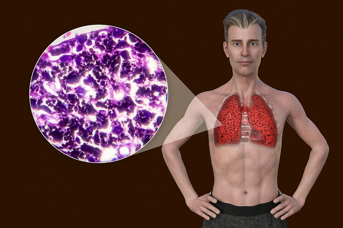 Man with smoker's lungs, illustration