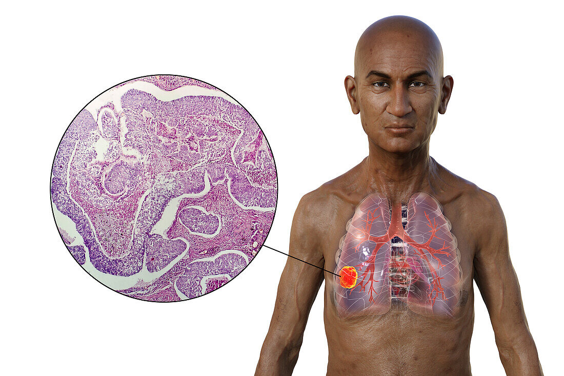 Man with lung cancer, illustration