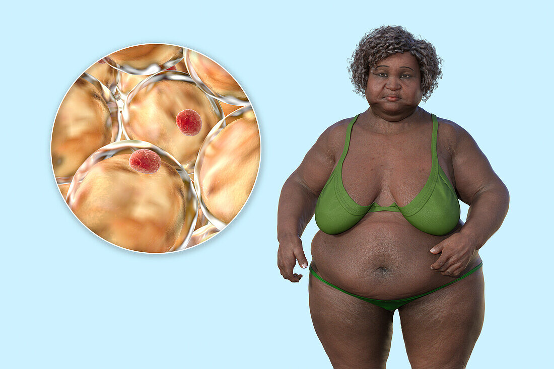 Overweight woman and adipocytes, illustration