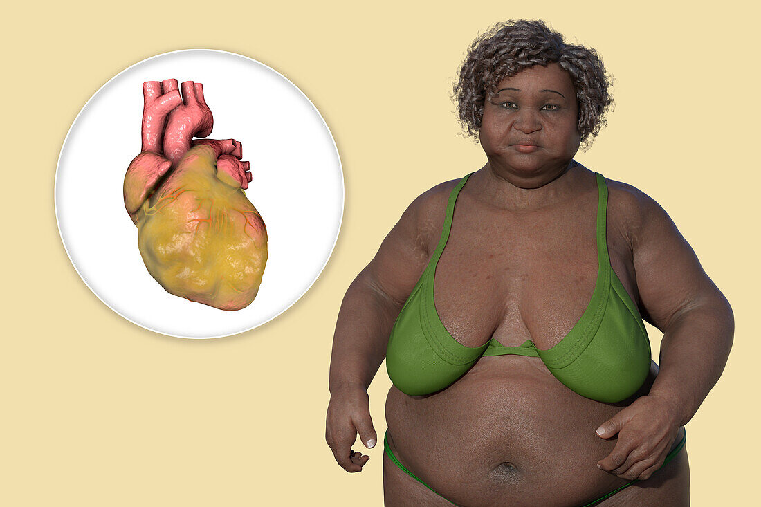 Overweight woman with enlarged heart, illustration