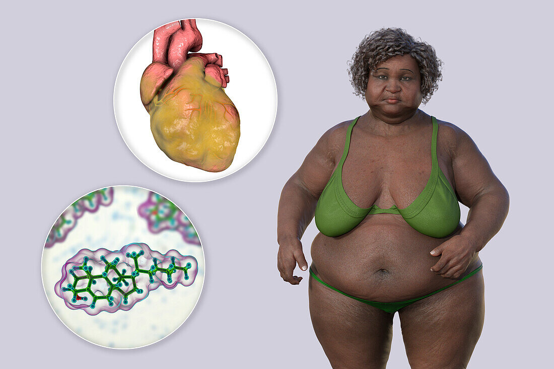 Overweight woman with enlarged heart, illustration