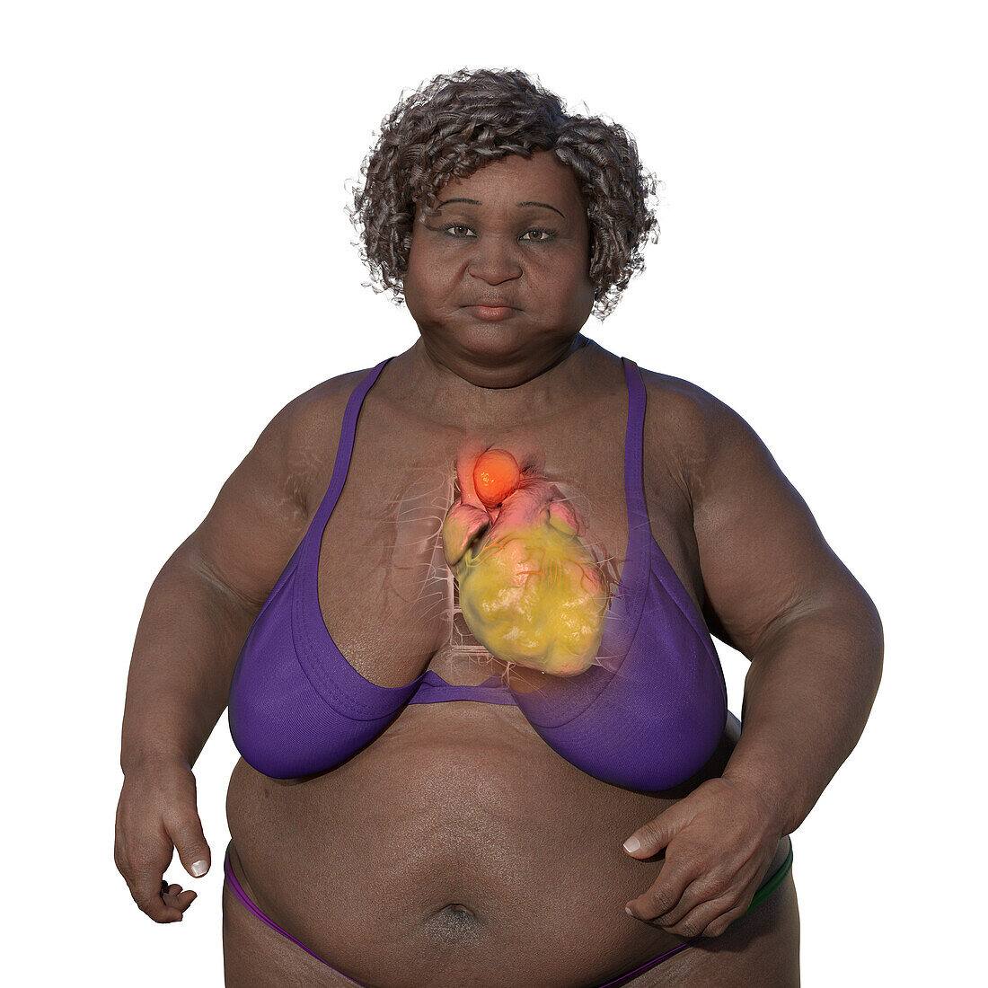 Obese woman with ascending aortic aneurysm, illustration