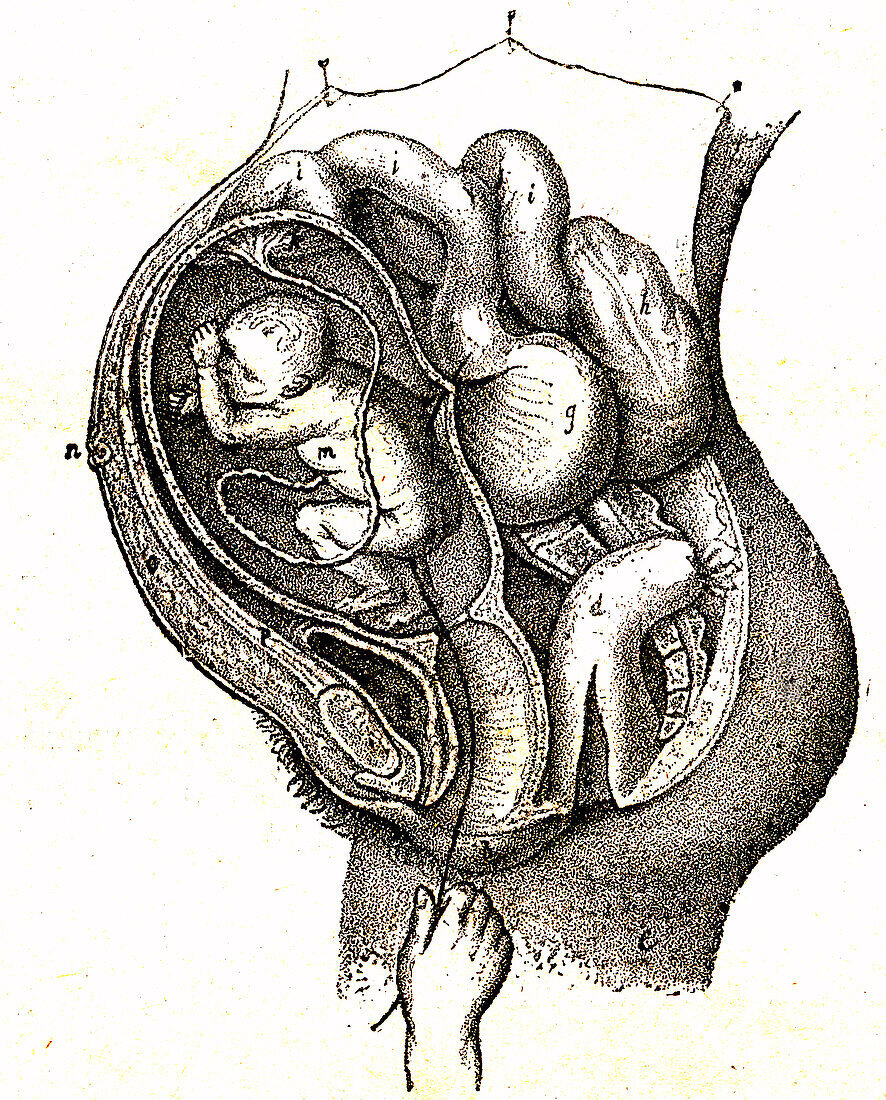 Perforated uterus during abortion, 19th century illustration