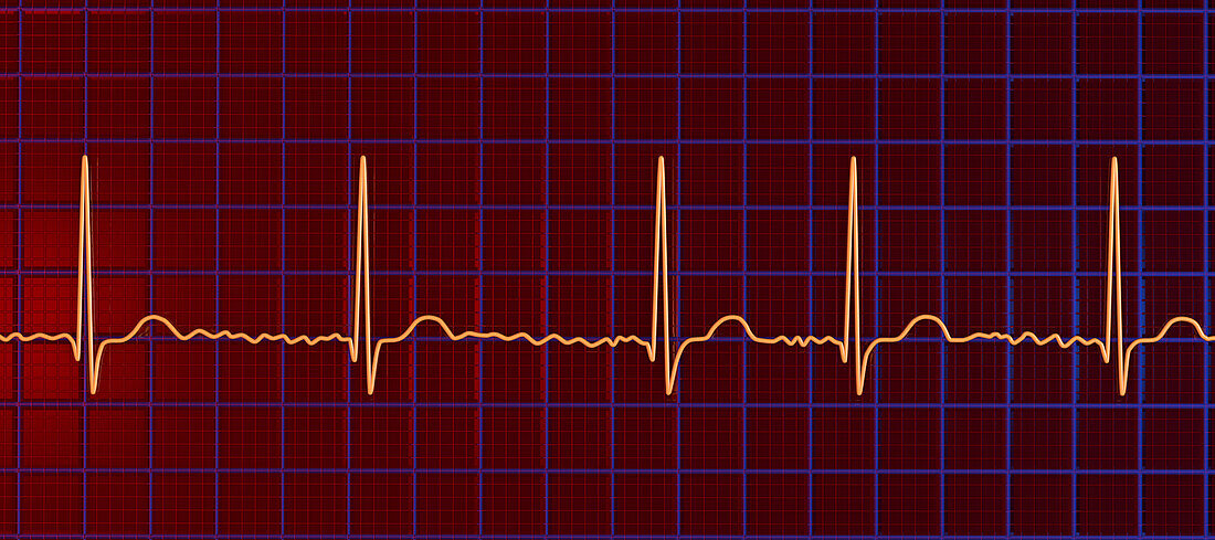 Atrial fibrillation irregular heartbeat rhythm, illustration