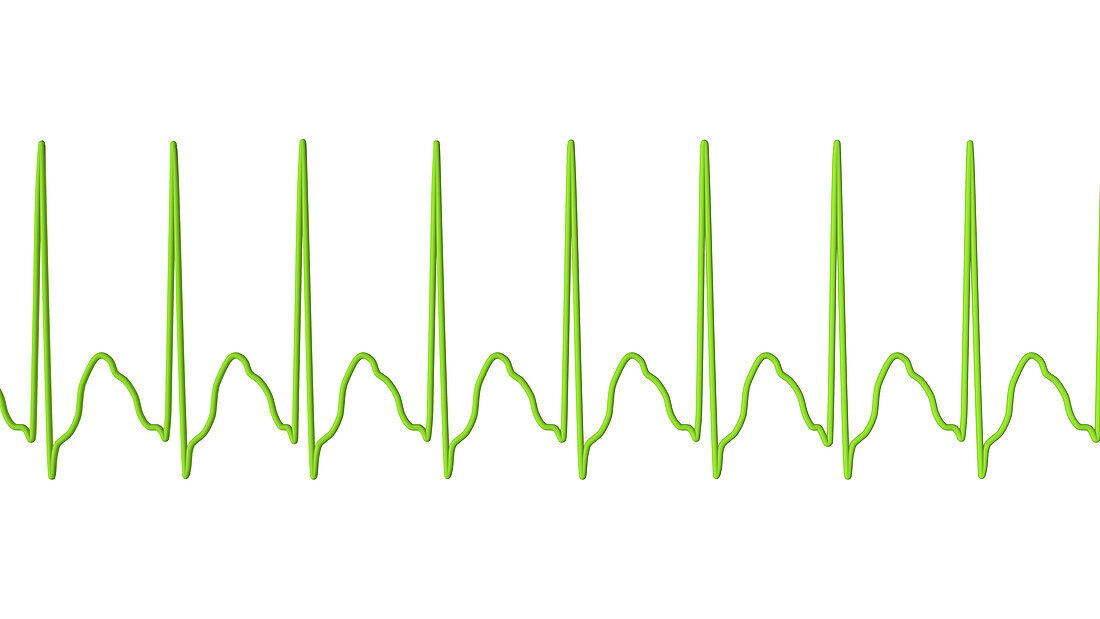 Supraventricular tachycardia heartbeat rhythm, illustration