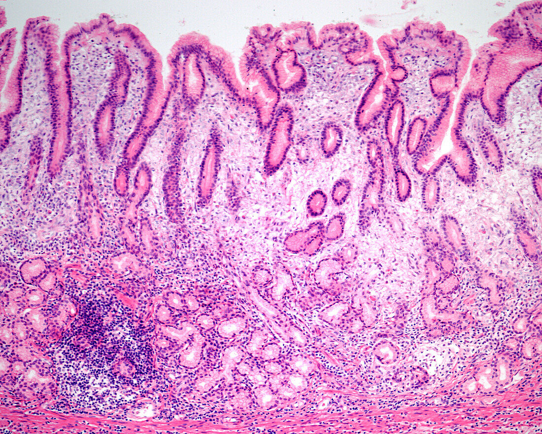 Chronic gastritis, light micrograph