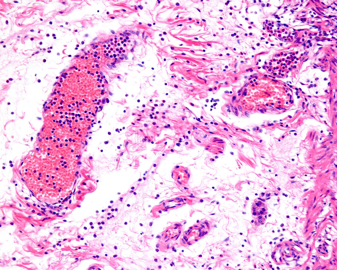 Inflammation in leukocyte diapedesis, light micrograph