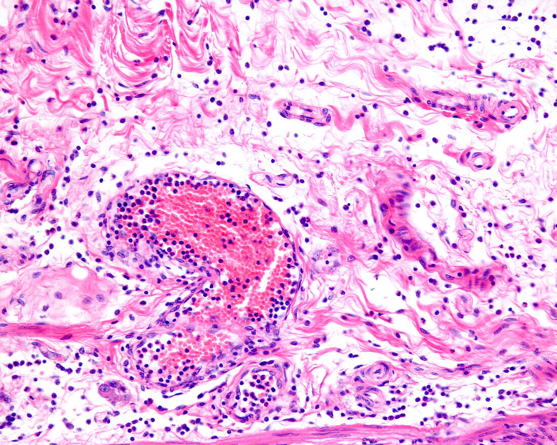 Inflammation in leukocyte diapedesis, light micrograph