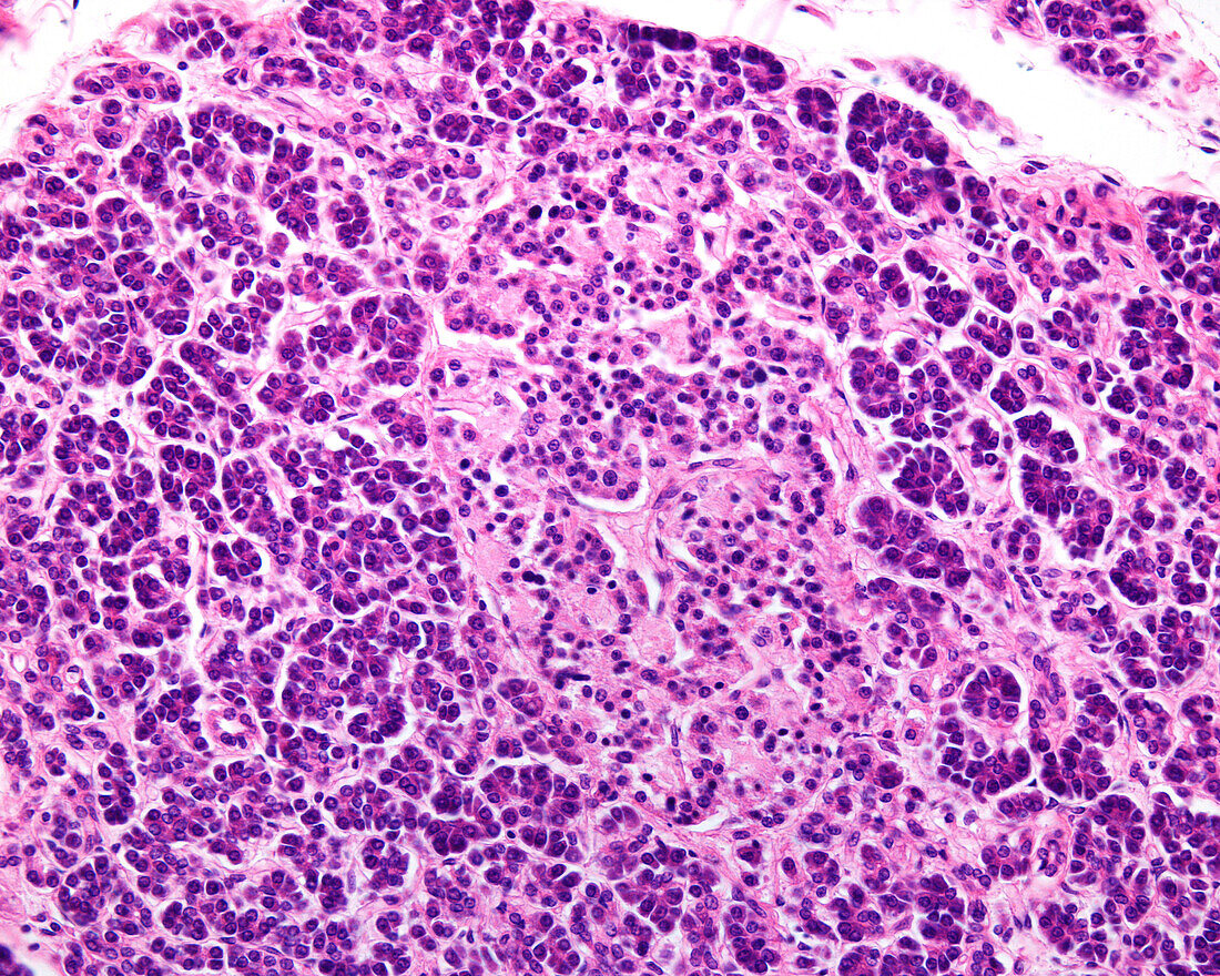 Pancreas in type 2 diabetes mellitus, light micrograph