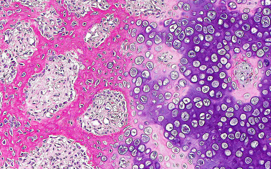 Woven bone and hyaline cartilage, light micrograph