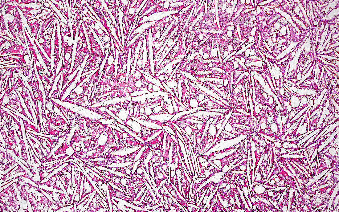 Cholesterol clefts, light micrograph