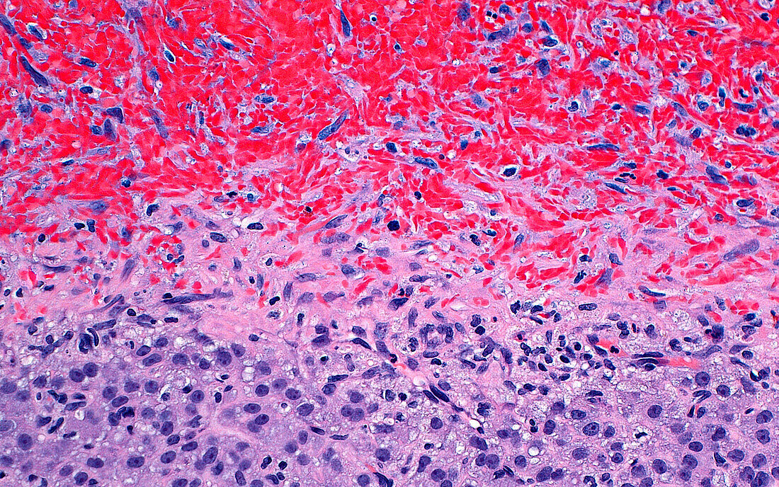 Haemorrhagic corpus luteum, light micrograph