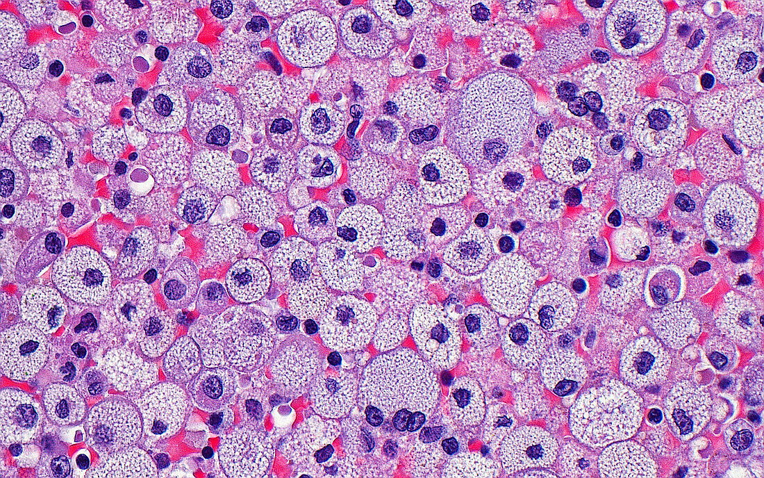 Foamy histiocytes, light micrograph