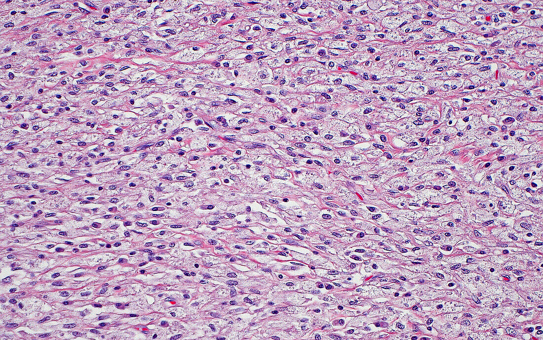 Tissue histiocytes, light micrograph