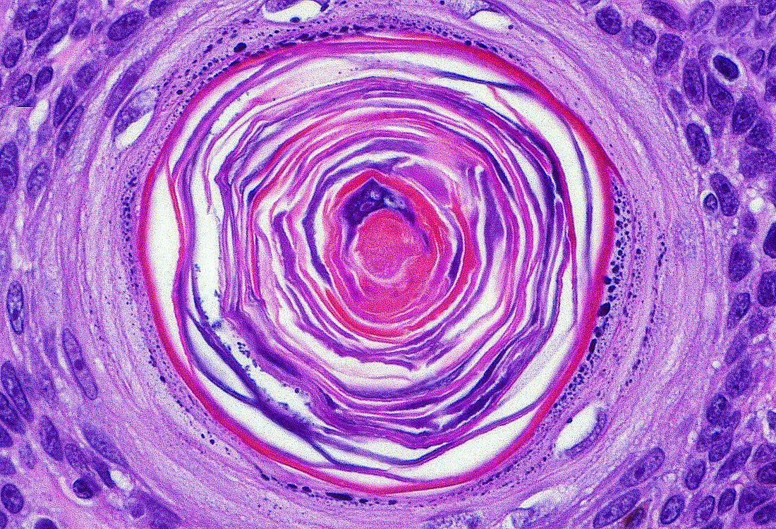 Keratin horn cyst (seborrheic keratosis), light micrograph